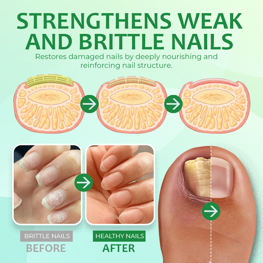 Ginger Nail Treatment Nail Support Nail Care