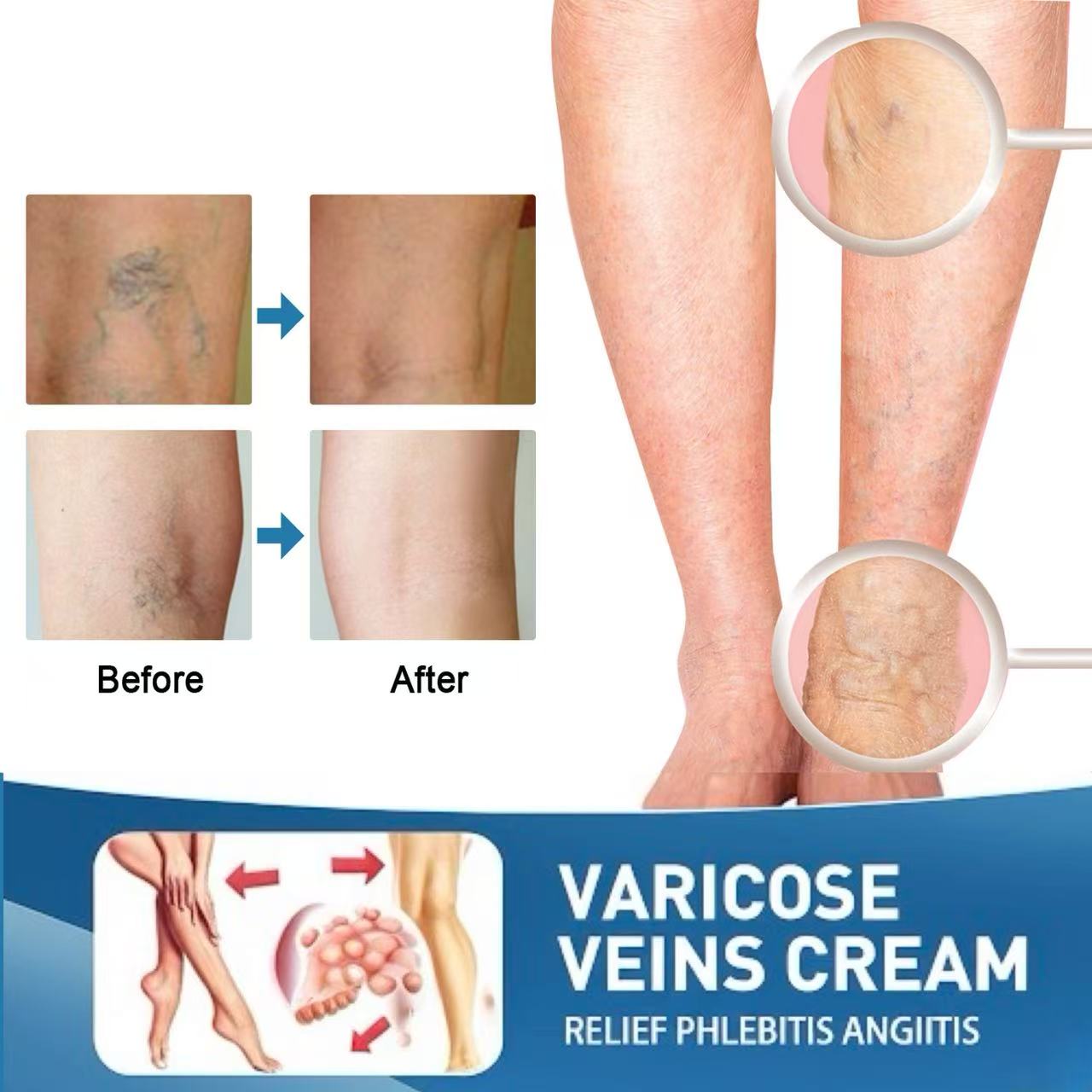 LBMLBM™ Effective Varicose Vein Relief Cream – Soothe Leg Pain & Improve Circulation