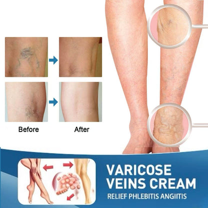 LBMLBM™ Effective Varicose Vein Relief Cream – Soothe Leg Pain & Improve Circulation