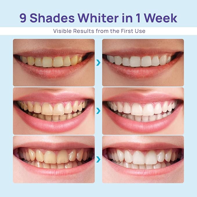 LBMLBM™ Teeth whitening device LED Accelerator Light- Whitens up to 10 Shades in 7 Days