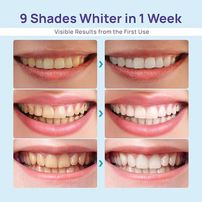LBMLBM™ Teeth whitening device LED Accelerator Light- Whitens up to 10 Shades in 7 Days