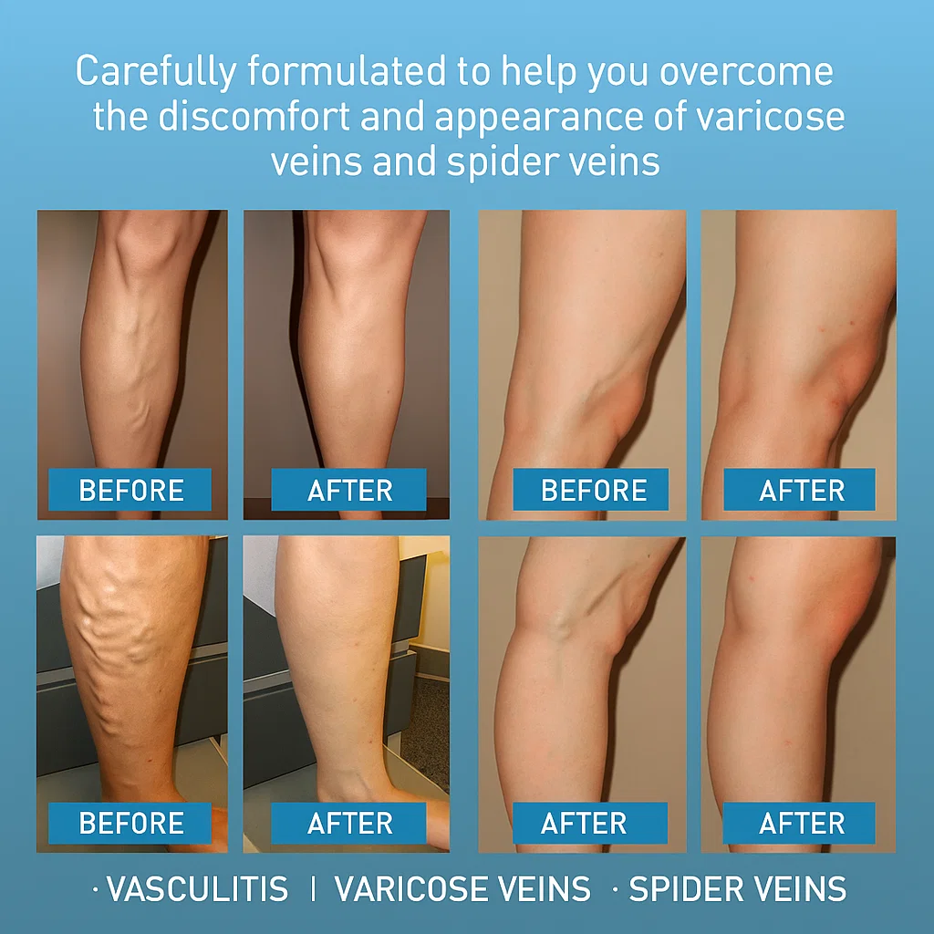 LBMLBM™ Effective Varicose Vein Relief Cream – Soothe Leg Pain & Improve Circulation